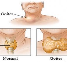 Guatrın en önemli nedeni iyot eksikliği