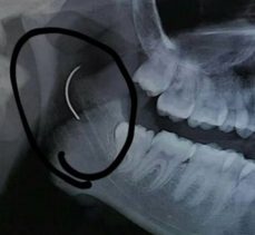 Boğazında ameliyat iğnesi ile 18 yıl yaşan hasta, Doktoru şok etti