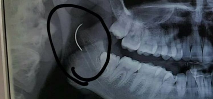 Boğazında ameliyat iğnesi ile 18 yıl yaşan hasta, Doktoru şok etti