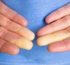 Raynaud hastalığı nedir? Belirtileri nelerdir?