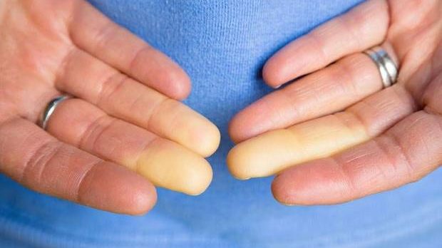 Raynaud hastalığı nedir? Belirtileri nelerdir?